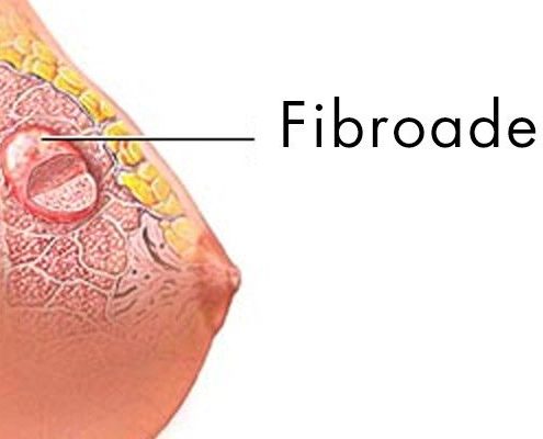 Fibroadenoma pode evoluir para câncer?