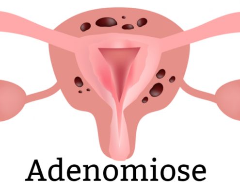 adenomiose é uma condição ginecológica em que o tecido do endométrio,